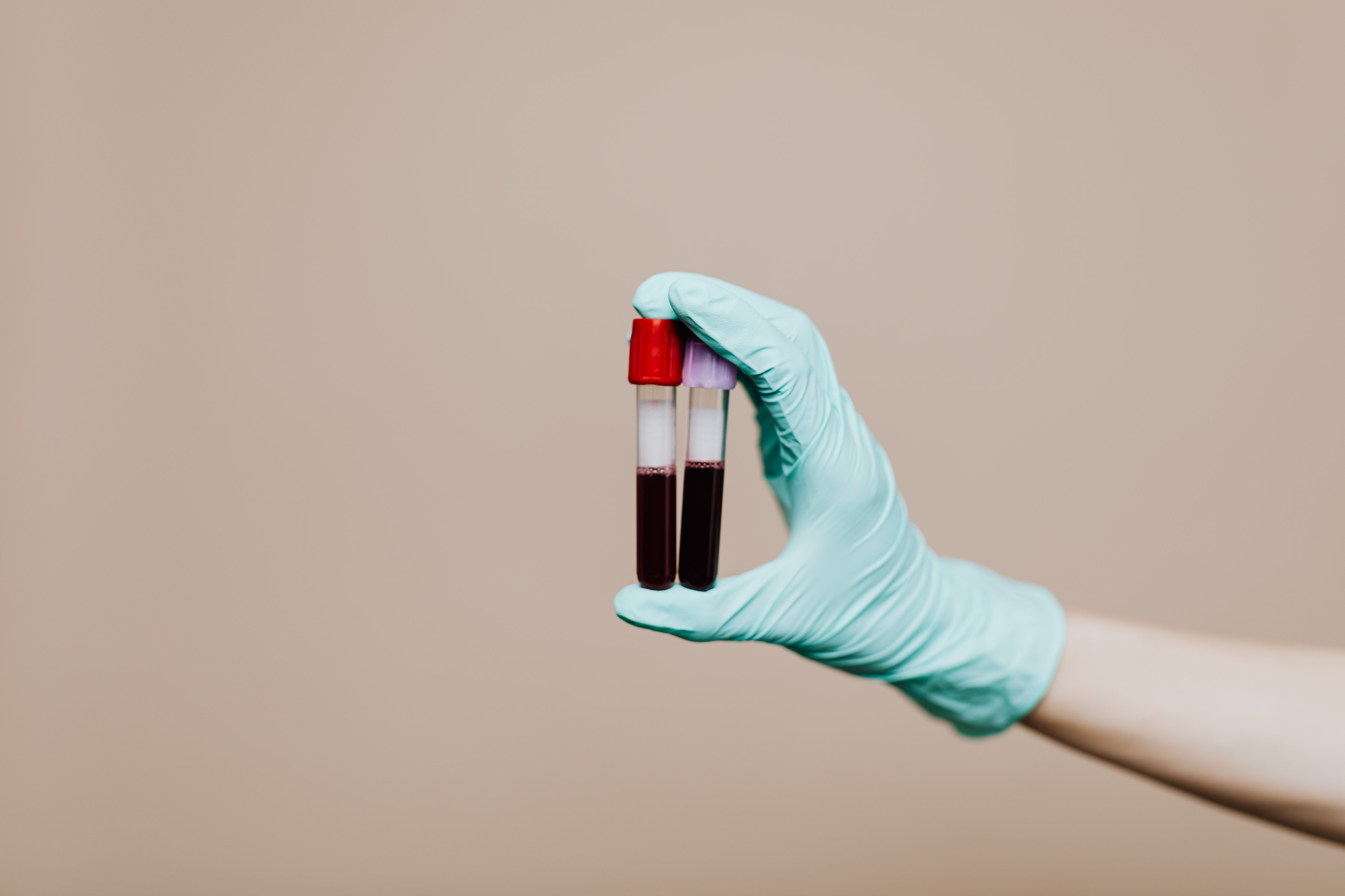 General Random Blood Sugar (GRBS) Test